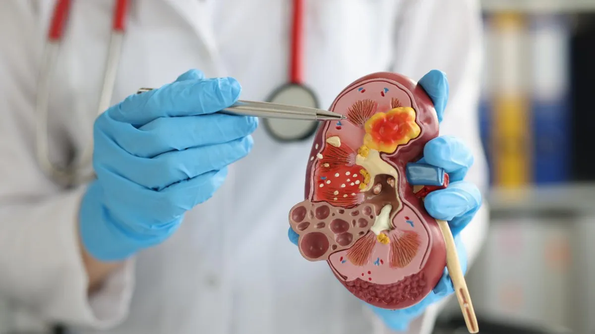 Salud llama a prevenir el cáncer de riñón que afecta principalmente a personas mayores de 50 años