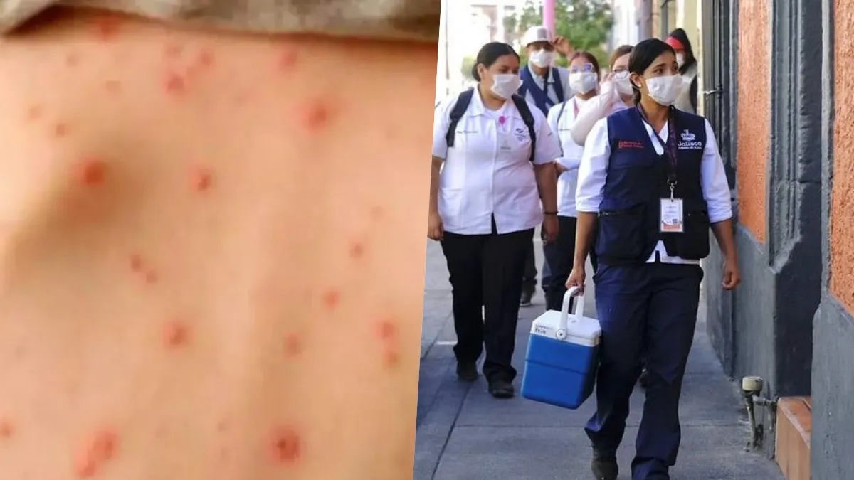 Se desborda sarampión en Jalisco; evidencian fallas en la acción preventiva